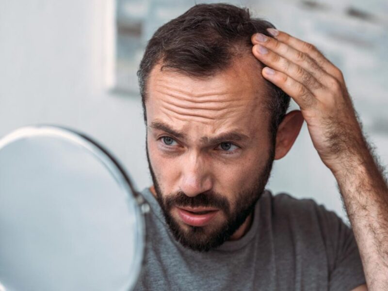 Bệnh rụng tóc này khác với bệnh hói ở nam giới.